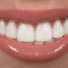 Saratoga Smile Care NSA Saratoga Springs-lips
