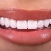 Advanced Dentistry Coronado-veneers