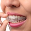 Tooth Braces in Pensacola, Florida