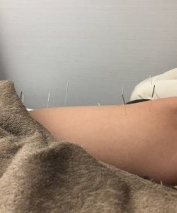 Foot Acupuncture in Sasebo, Japan